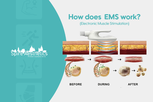 EMS treatment for post pregnancy weight loss treatment Biggleswade