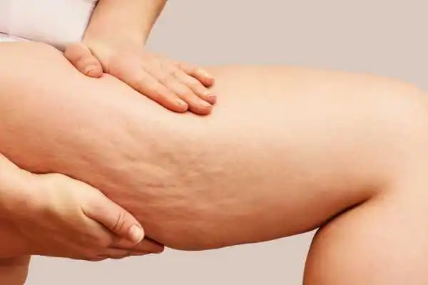 Image of woman showing leg with cellulite Biggleswade
