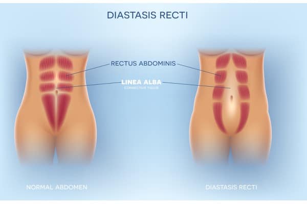 What Non-Surgical Options Are Available for Diastasis Recti Biggleswade?
