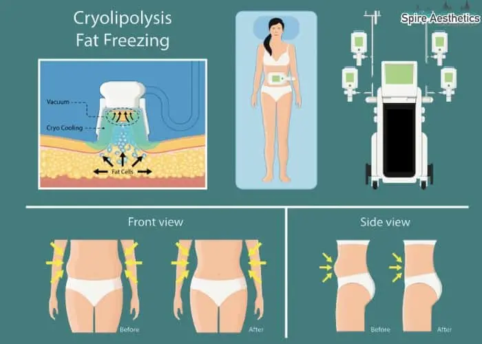 Fat freezing treatment Biggleswade benefits for competitions to remove stubborn fat deposits.