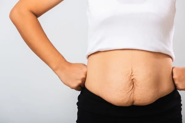 Image of a woman's stomach after weight loss with sagging skin following a gastric band Biggleswade