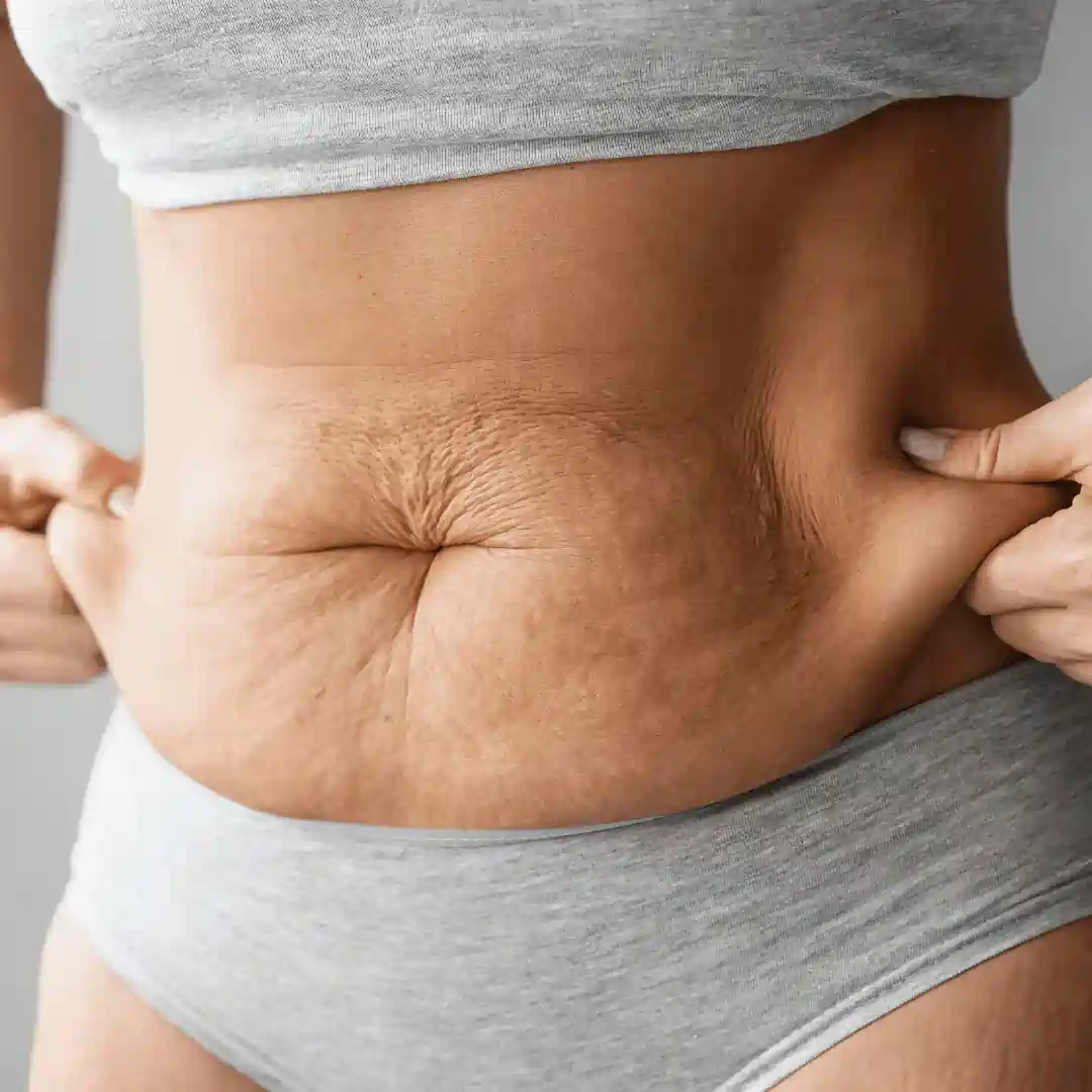 Is It Normal to Have Loose Skin After Pregnancy Biggleswade?