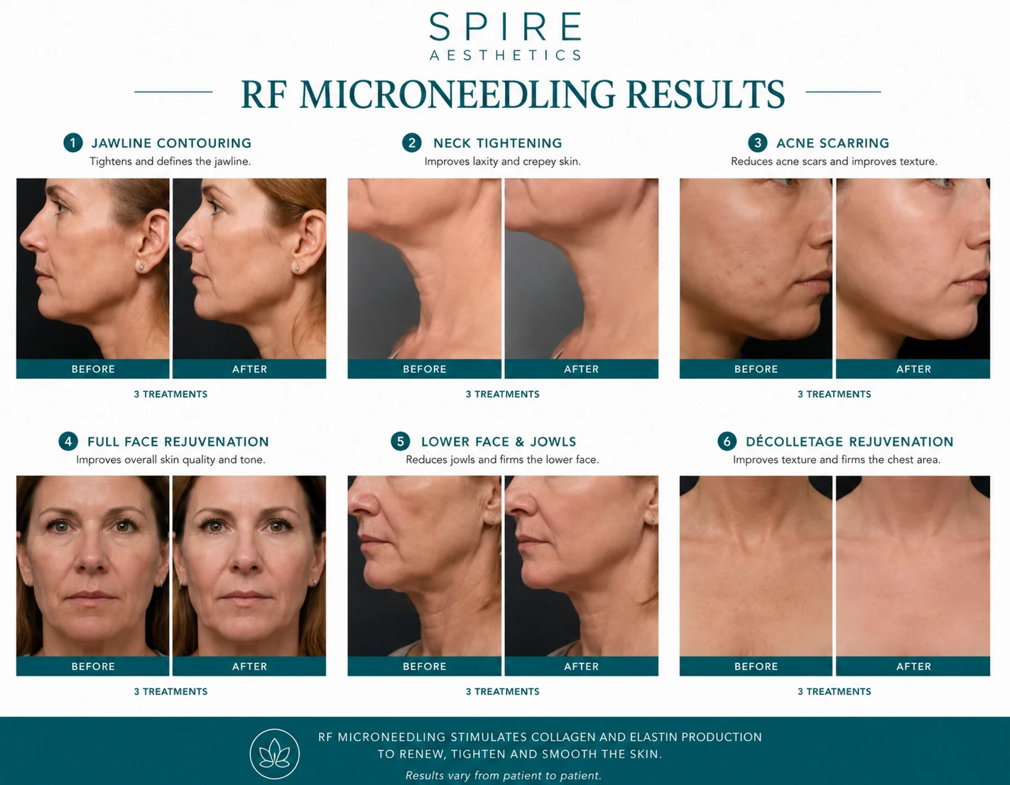RF Microneedling Skin tightening Biggleswade results