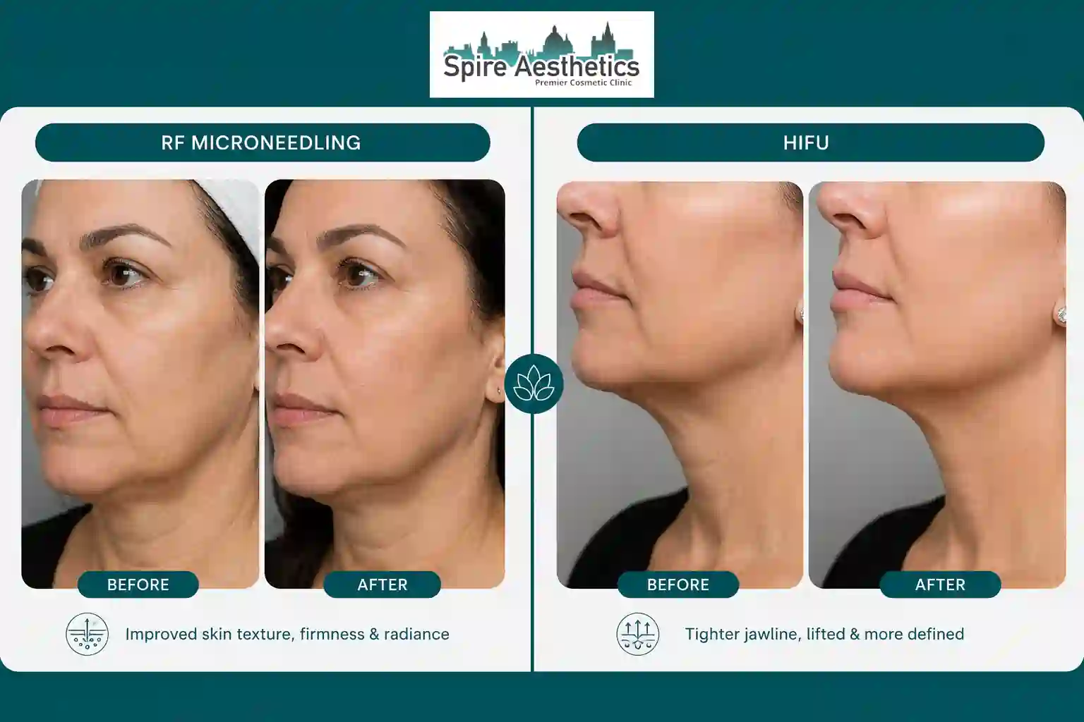 Can RF Microneedling and HIFU Be Combined Biggleswade?