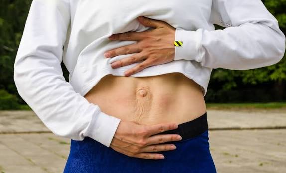 When Could Diastasis Recti Be the Missing Piece of the Puzzle Biggleswade?