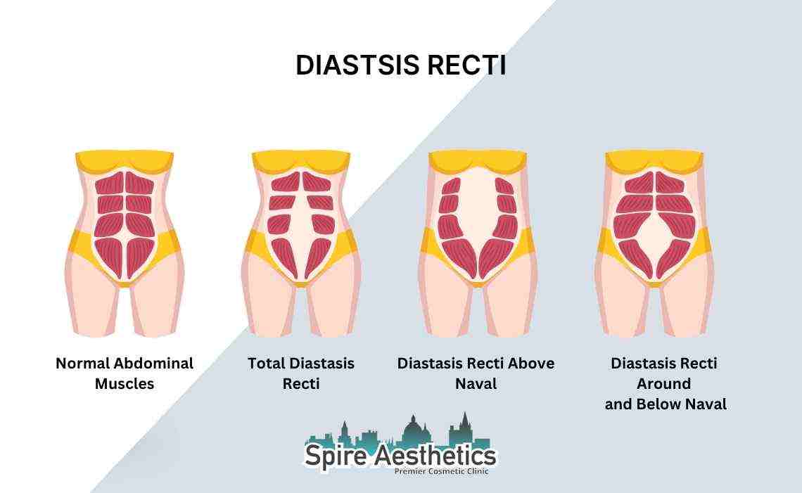 Is Non-Surgical Diastasis Recti Treatment Right for You? Common Concerns Answered Biggleswade